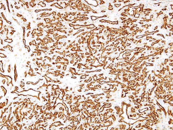 9B1 Hemangioma (Case 9) CD31 1