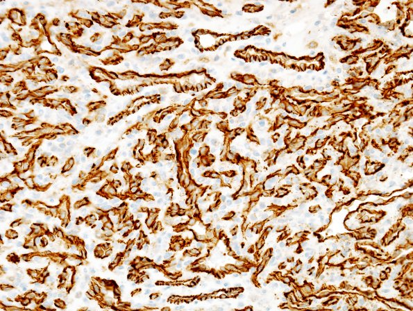 9B2 Hemangioma (Case 9) CD31 2