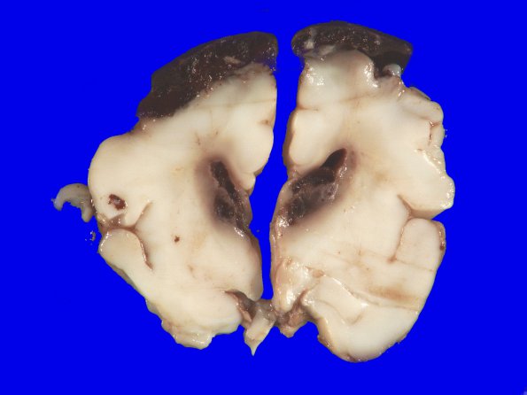 10A1 Hemorrhage, intraventricular, neonatal & meningitis (Case 10) Gross_5