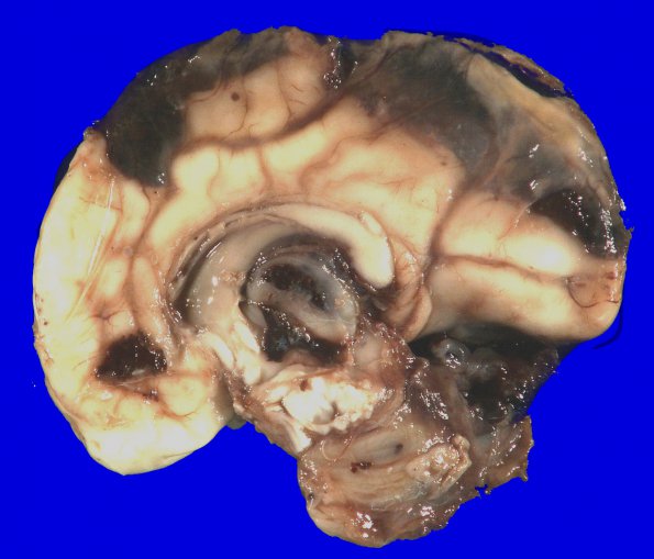 10A2 Hemorrhage, intraventricular, neonatal & meningitis (Case 10) Gross_2