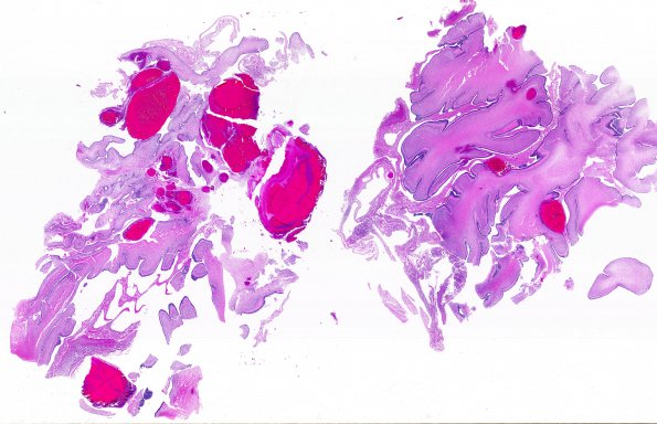 10B Hemorrhage, intraventricular, neonatal & meningitis (Case 10)