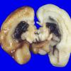 11A1 Hemorrhage, IVH 24wk twin A (Case 11)