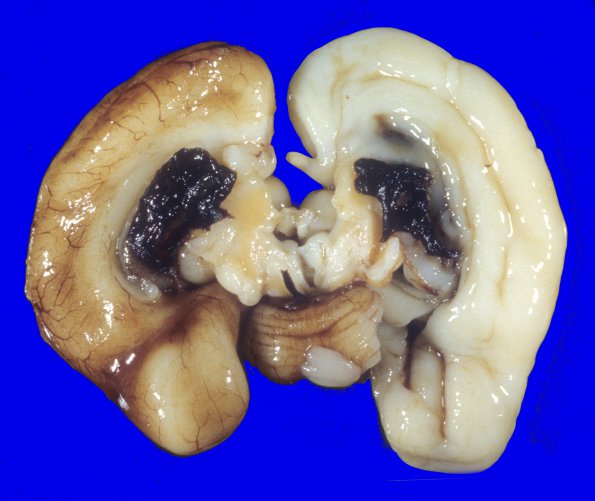 11A1 Hemorrhage, IVH 24wk twin A (Case 11)