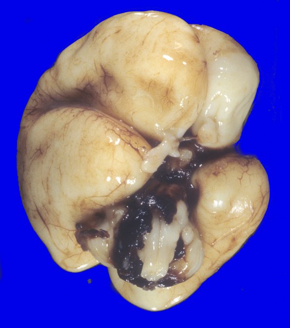 11A2 Hemorrhage, IVH 24wk twin B (Case 11)