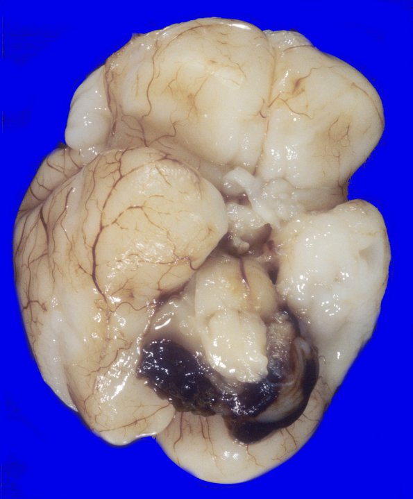 12A1 Hemorrhage, IVH (Case 12) 2