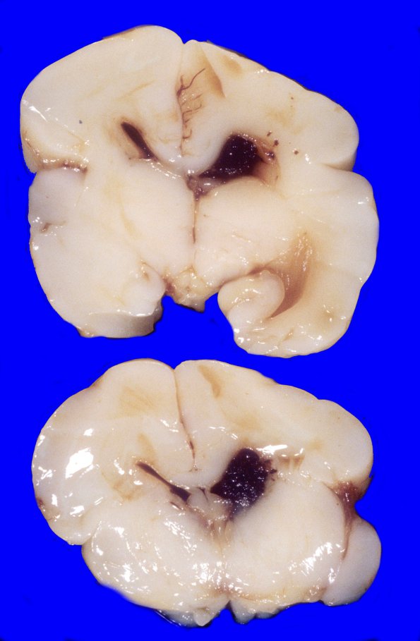 12A2 Hemorrhage, IVH (Case 12) 3