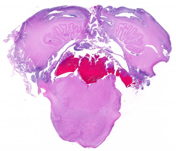 13B  Hemorrhage, SEGM (Case 13) H&E IV Luschka