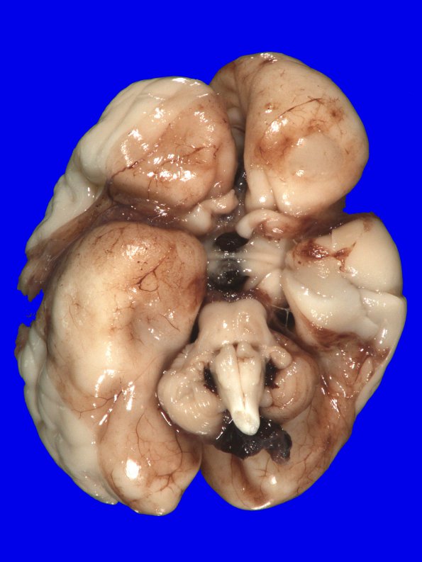 14A1 Hemorrhage, neonatal, premature (Case 14) gross_2