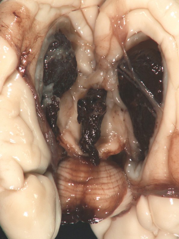 14A3 Hemorrhage, neonatal, premature (Case 14) gross_3