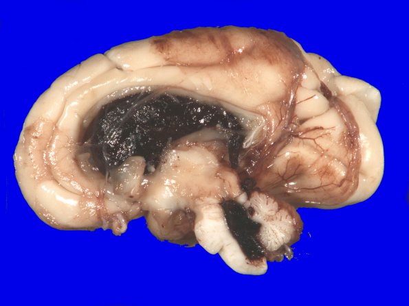 14A4 Hemorrhage, neonatal, premature (Case 14) gross_4