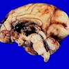 15A1 Hemorrhage, neonatal (Case 15) 1