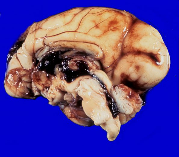 15A1 Hemorrhage, neonatal (Case 15) 1