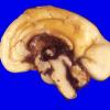 16A1 Hemorrhage, neonatal, IVH (Case 16)