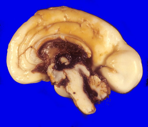 16A1 Hemorrhage, neonatal, IVH (Case 16)