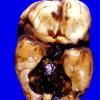 17A1 Hemorrhage, Neonatal, Subependymal Germinal Matrix gross 1