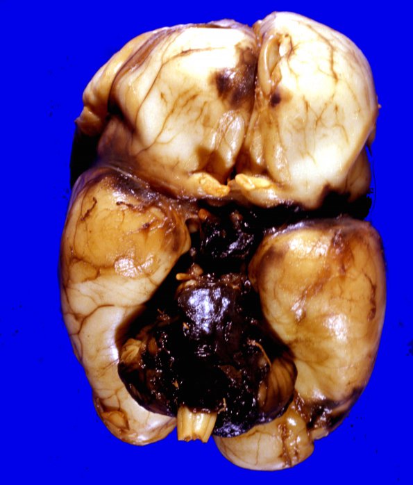 17A1 Hemorrhage, Neonatal, Subependymal Germinal Matrix gross 1