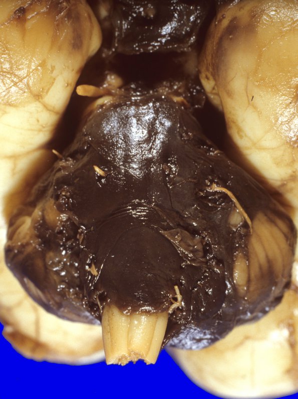 17A2 Hemorrhage, neonatal (WUMS Case) 4