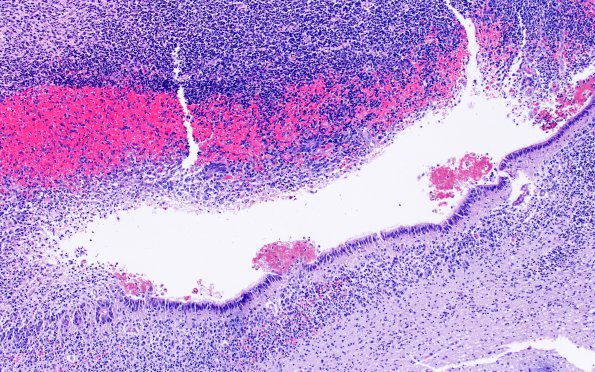 18B1 Hemorrhage, neonatal (Case 18) H&E 4