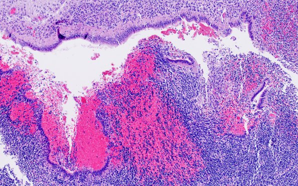 18B2 Hemorrhage, neonatal (Case 18) H&E 3