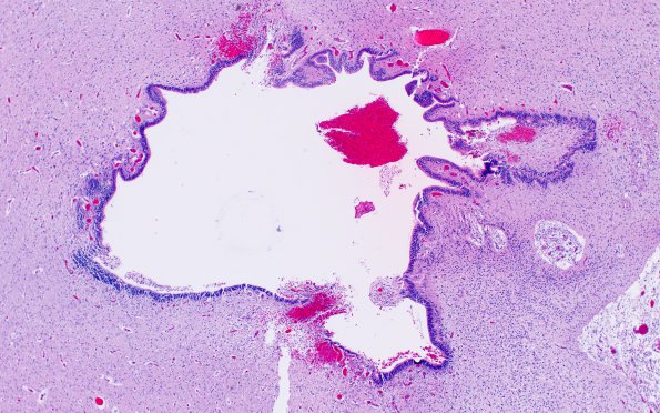 18B3 Hemorrhage, neonatal (Case 18) H&E 2