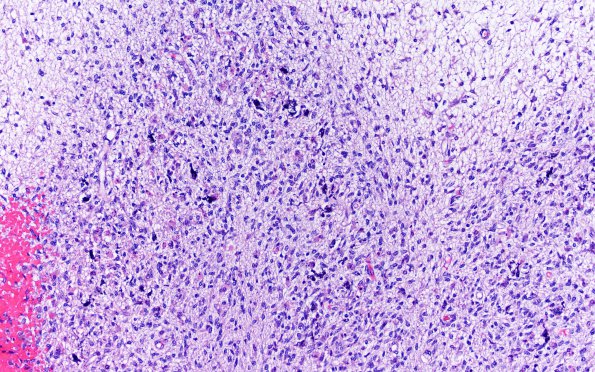 18B4 Hemorrhage, neonatal (Case 18) H&E 1