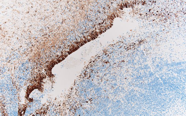 18C Hemorrhage, neonatal (Case 18) GFAP 1