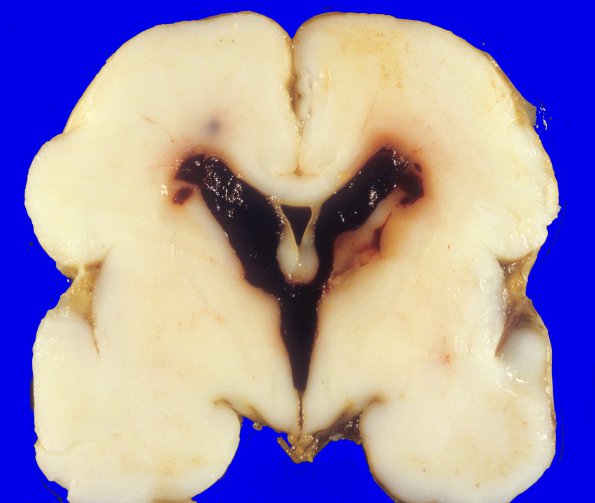 19A1 Hemorrhage, neonatal, SEGM, IVH (Case 19) 5