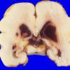 19A2 Hemorrhage, neonatal, SEGM, IVH (Case 19) 4