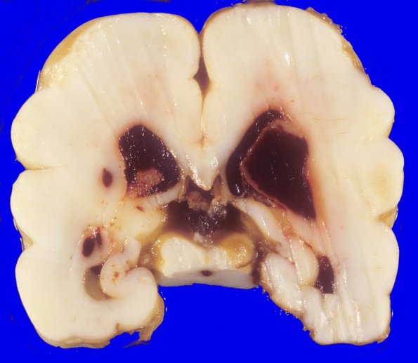 19A2 Hemorrhage, neonatal, SEGM, IVH (Case 19) 4