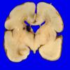 1A Hemorrhage, SEGM, 27 wk old (Case 1)