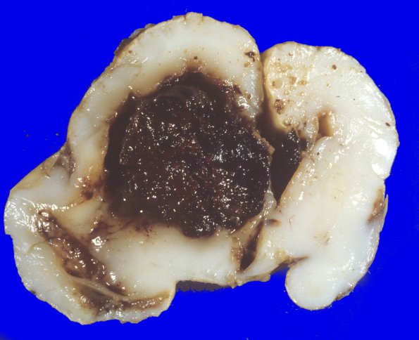 20A1 Hemorrhage, neonatal (WUMS Case) 7