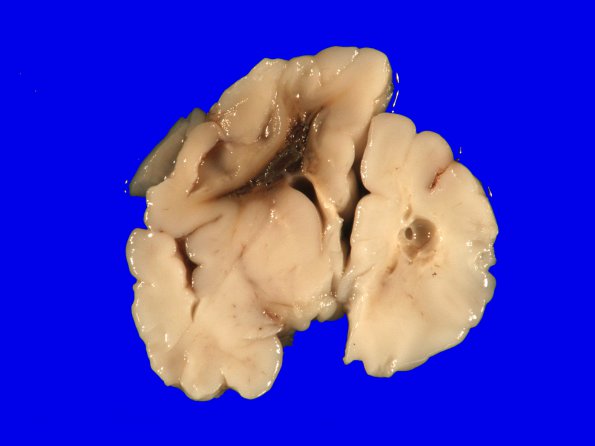 21A1 Hypoxic-Ischemic & Hemorrhage, neonatal (Case 21) 4