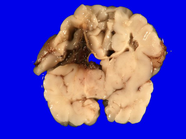 21A2 Hypoxic-Ischemic & Hemorrhage, neonatal (Case 21) 5