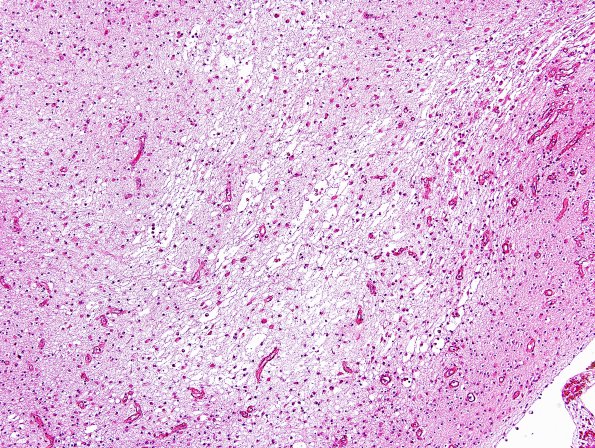 21B2 Hypoxic-Ischemic & Hemorrhage, neonatal (Case 21) H&E 4