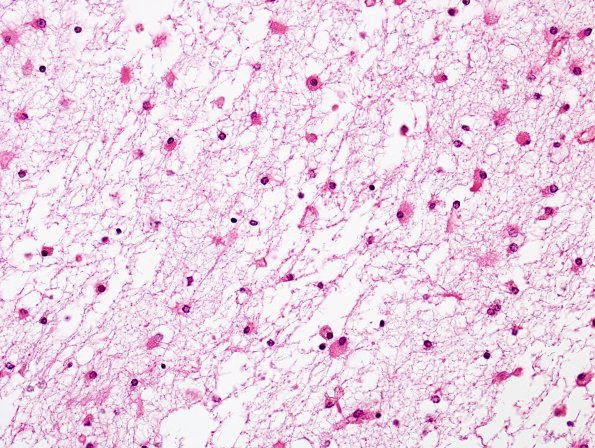 21B3 Hypoxic-Ischemic & Hemorrhage, neonatal (Case 21 H&E 5