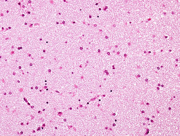 21B4 Hypoxic-Ischemic & Hemorrhage, neonatal (Case 21) H&E 14