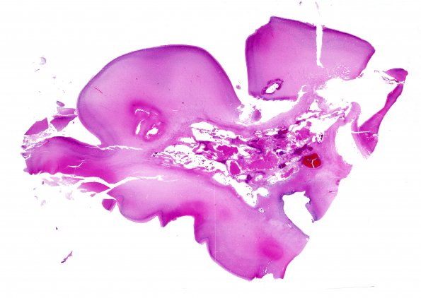 21C1 Hypoxic-Ischemic & Hemorrhage, neonatal (Case 21) H&E whole mount 1