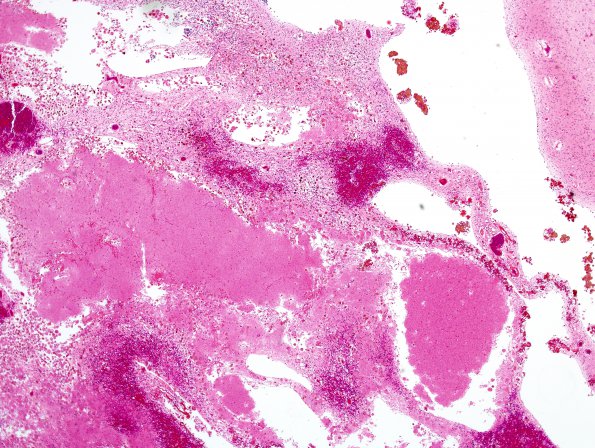 21C2 Hypoxic-Ischemic & Hemorrhage, neonatal (Case 21) H&E 10