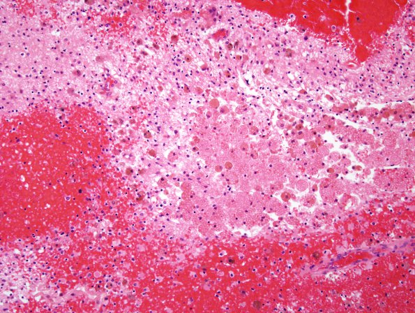 21C3 Hypoxic-Ischemic & Hemorrhage, neonatal (Case 21) H&E 11