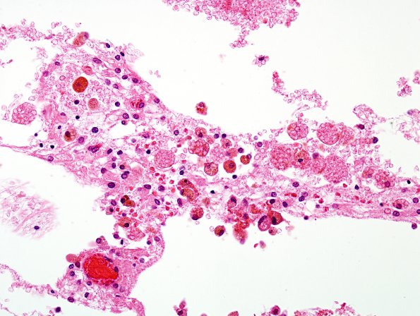 21C4 Hypoxic-Ischemic & Hemorrhage, neonatal (Case 21) H&E 22