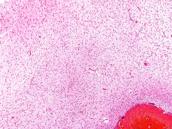 21C5 Hypoxic-Ischemic & Hemorrhage, neonatal (Case 21) H&E 21