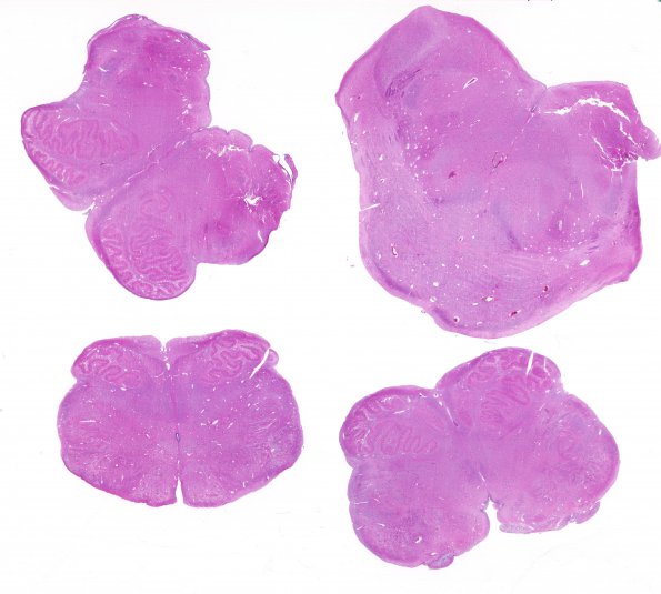 21D1 Hypoxic-Ischemic & Hemorrhage, neonatal (Case 21) H&E whole mount