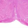 21D2 Hypoxic-Ischemic & Hemorrhage, neonatal (Case 21) H&E 9