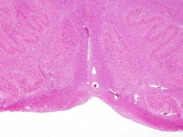 21D2 Hypoxic-Ischemic & Hemorrhage, neonatal (Case 21) H&E 9