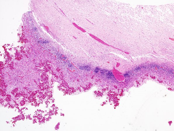 22A1 Hemorrhage, neonatal, IVH, gran ependymitis & extensive infarcts (Case 22) 2