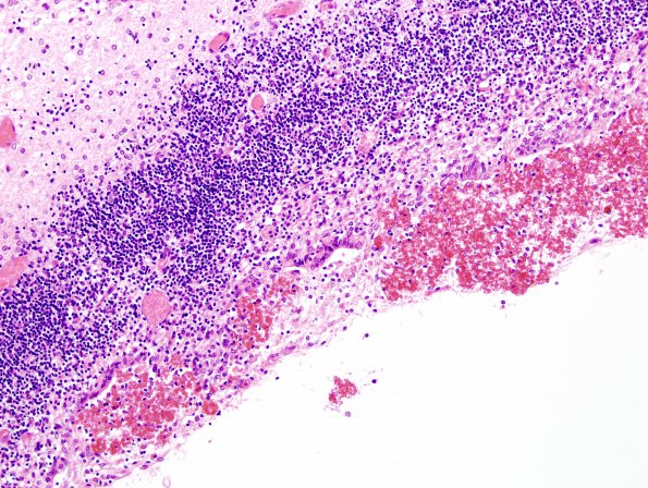 22A2 Hemorrhage, neonatal, IVH, gran ependymitis & extensive infarcts (Case 22) 4