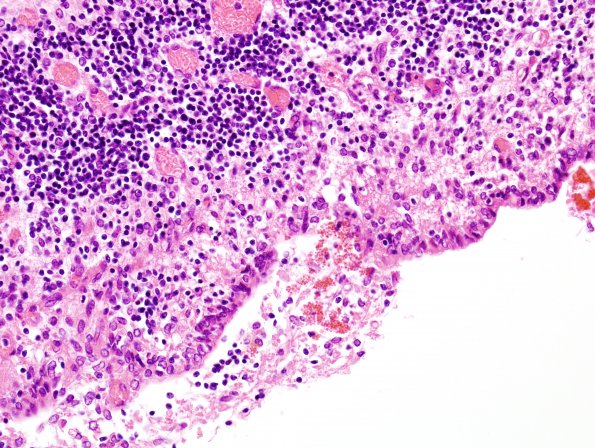 22A3 Hemorrhage, neonatal, IVH, gran ependymitis & extensive infarcts (Case 22) 3