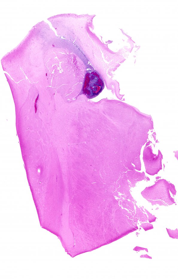 23A1 Hypoxia-Ischemia, Neonate, intrauterine (Case 23) H&E WM 3