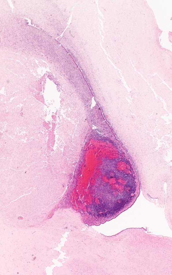 23A2 SEGM Hemorrhage (Case 23) N1 H&E 2X