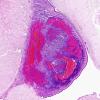 23A3 Hypoxia-Ischemia, Neonate, intrauterine (Case 23) H&E 2